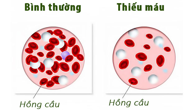 6. Phòng bệnh thiếu máu do thiếu sắt
