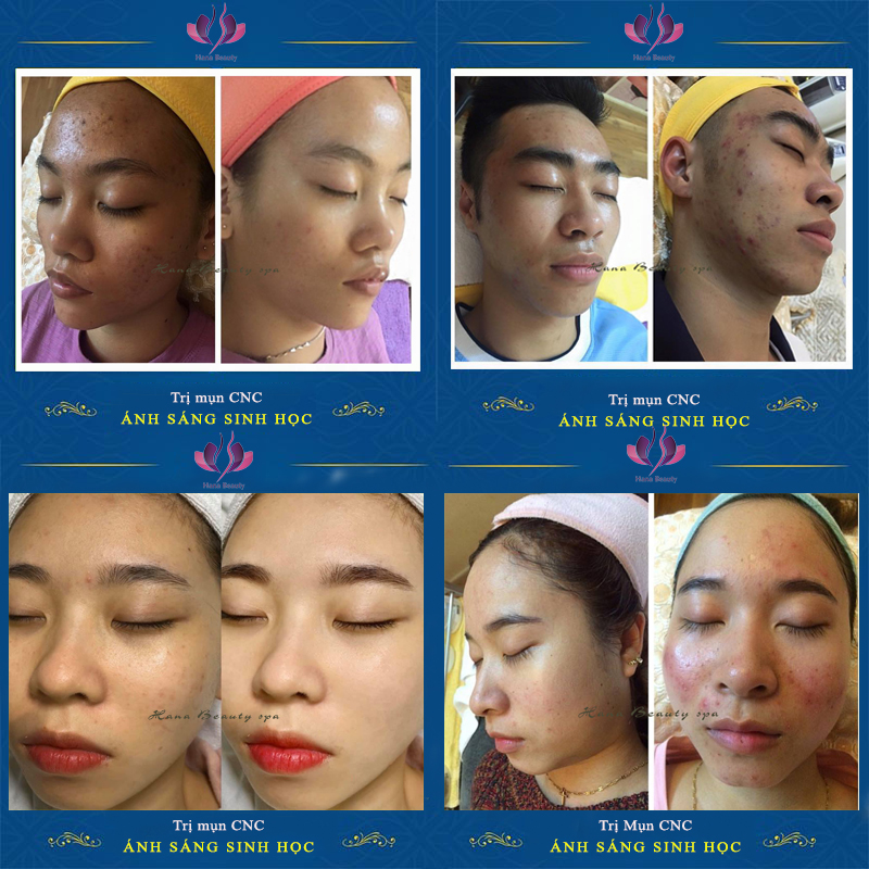 Kết quả trị mụn tại Hana Beauty spa