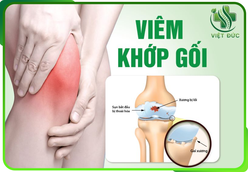 Bệnh viêm khớp