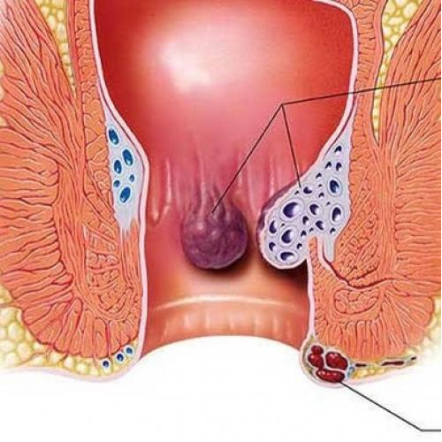 Những Biểu Hiện Báo Hiệu Bệnh Trĩ – Cách Chữa Bệnh Trĩ